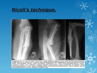 Nicoll’s technique.
 