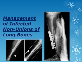 Management
of Infected
Non-Unions of
Long Bones
 