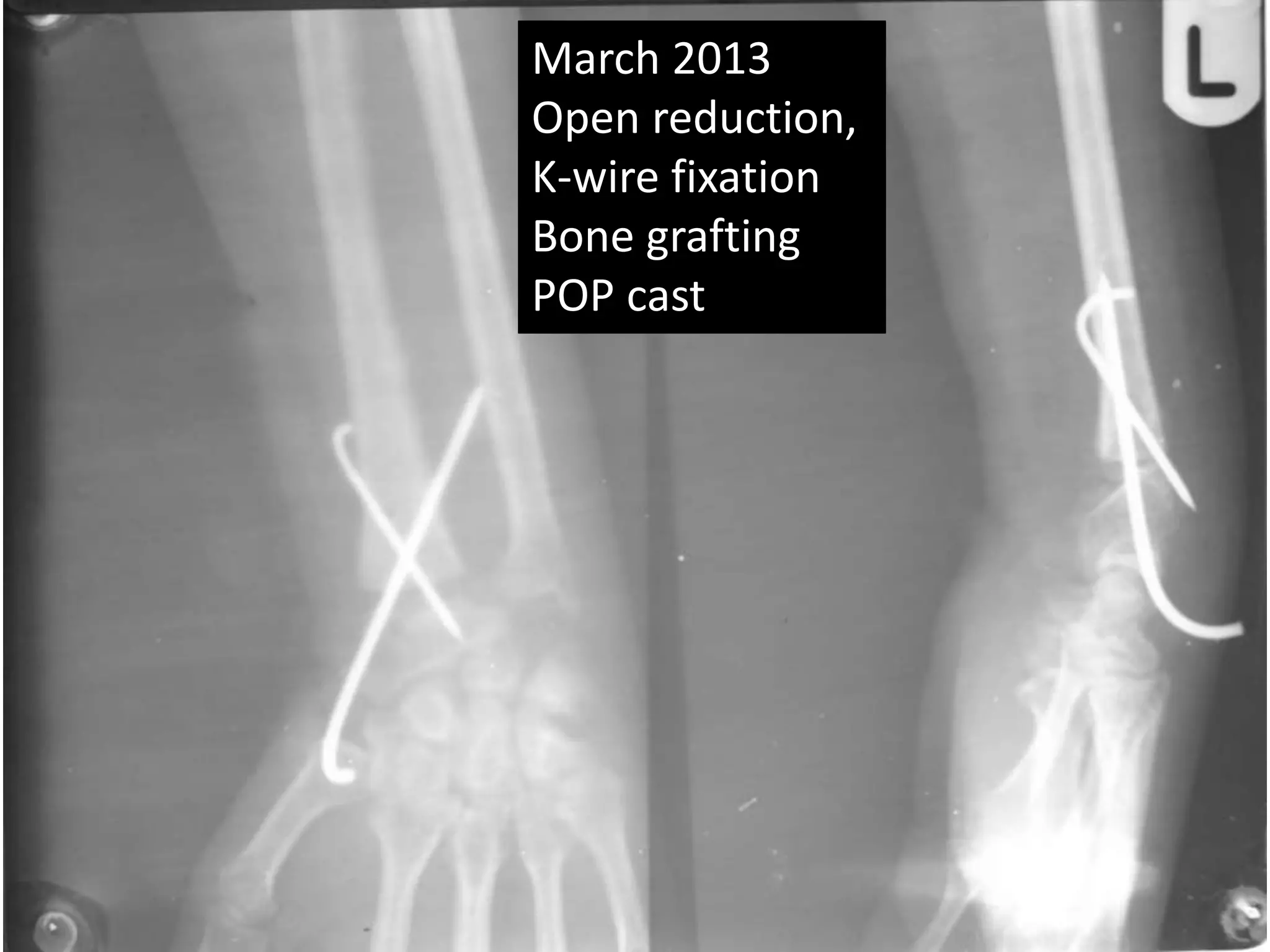 March 2013 
Open reduction, 
K-wire fixation 
Bone grafting 
POP cast 
 