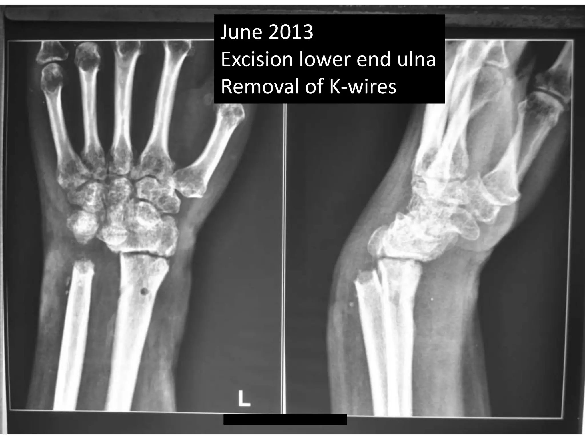 June 2013 
Excision lower end ulna 
Removal of K-wires 
 