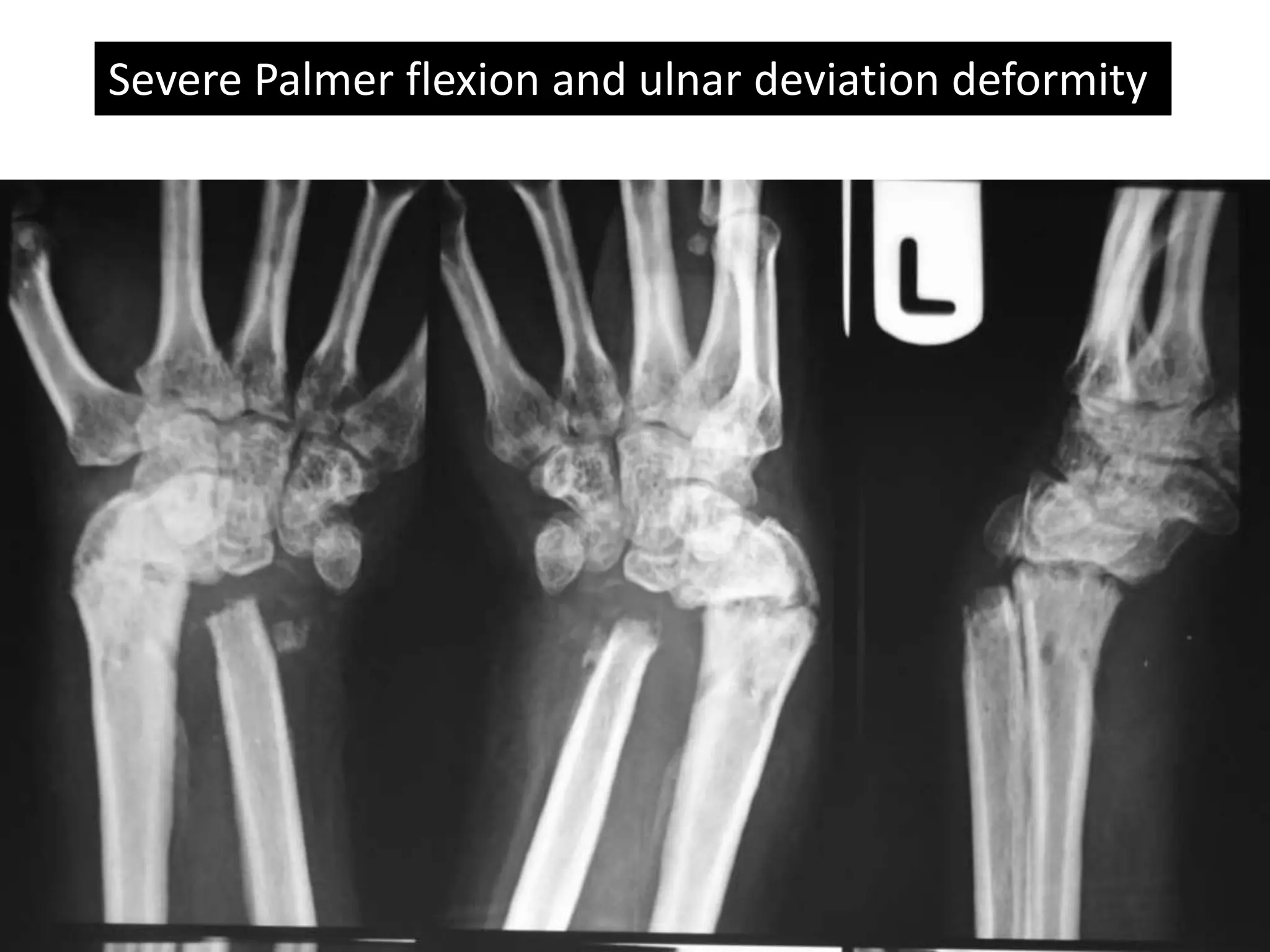 Severe Palmer flexion and ulnar deviation deformity 
 
