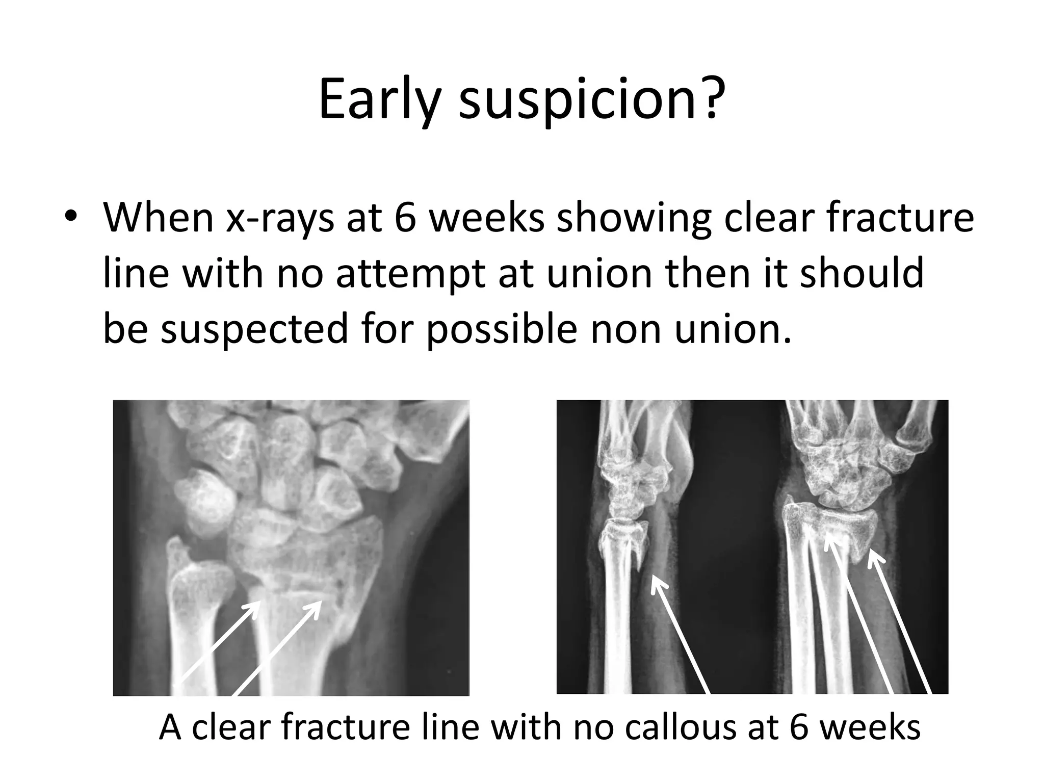 Early suspicion? 
• When x-rays at 6 weeks showing clear fracture 
line with no attempt at union then it should 
be suspected for possible non union. 
A clear fracture line with no callous at 6 weeks 
 