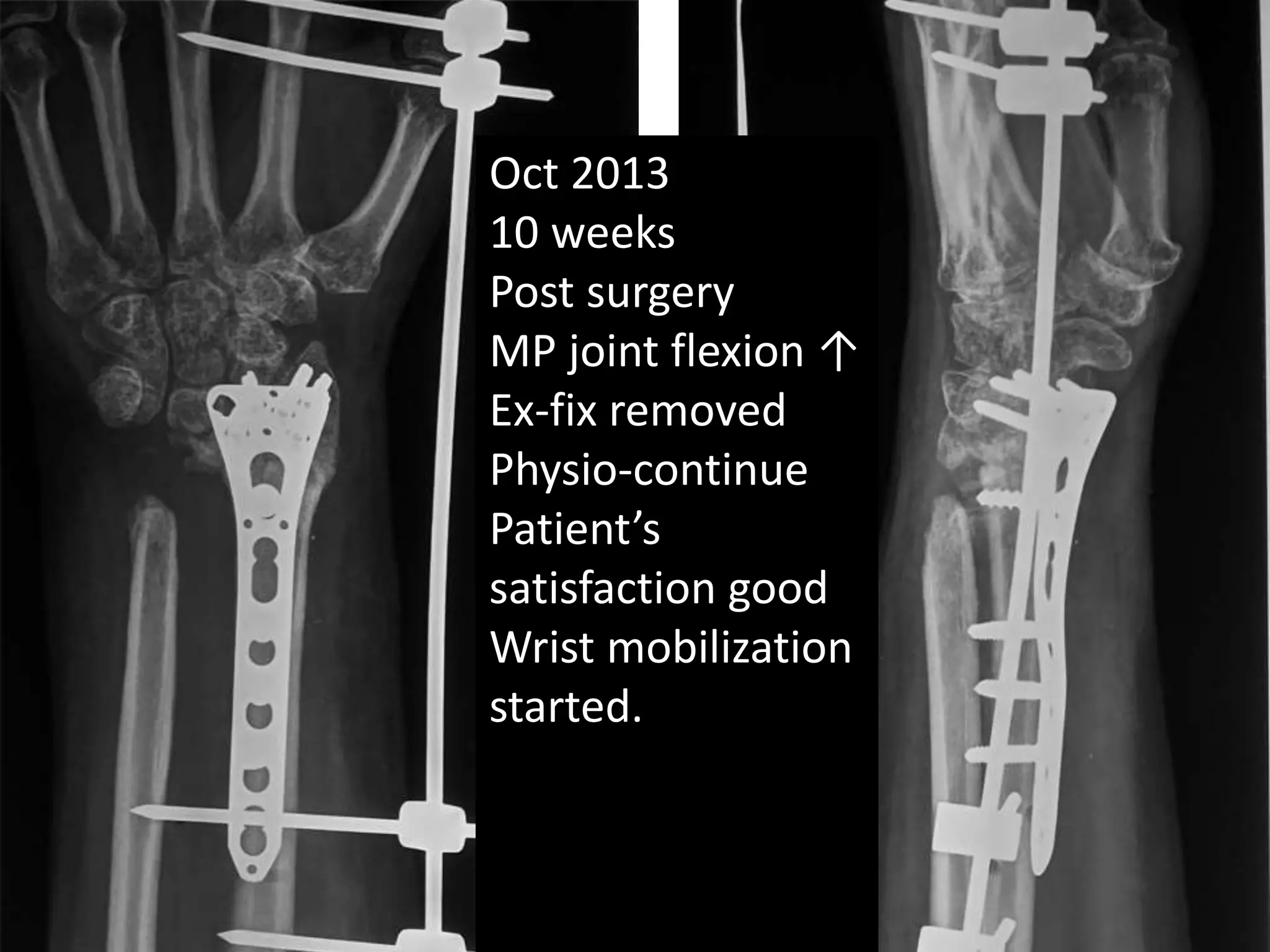 Oct 2013 
10 weeks 
Post surgery 
MP joint flexion ↑ 
Ex-fix removed 
Physio-continue 
Patient’s 
satisfaction good 
Wrist mobilization 
started. 
 