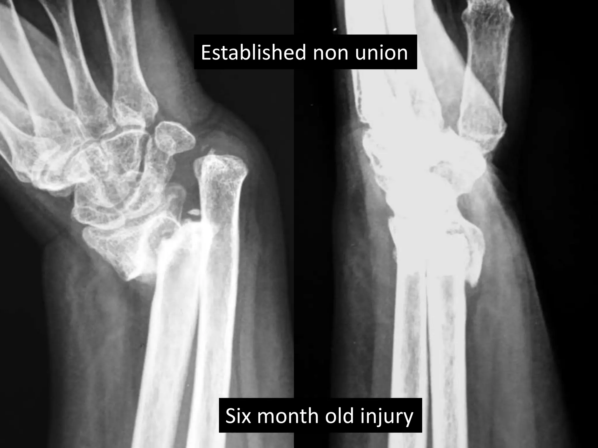 Established non union 
Six month old injury 
 