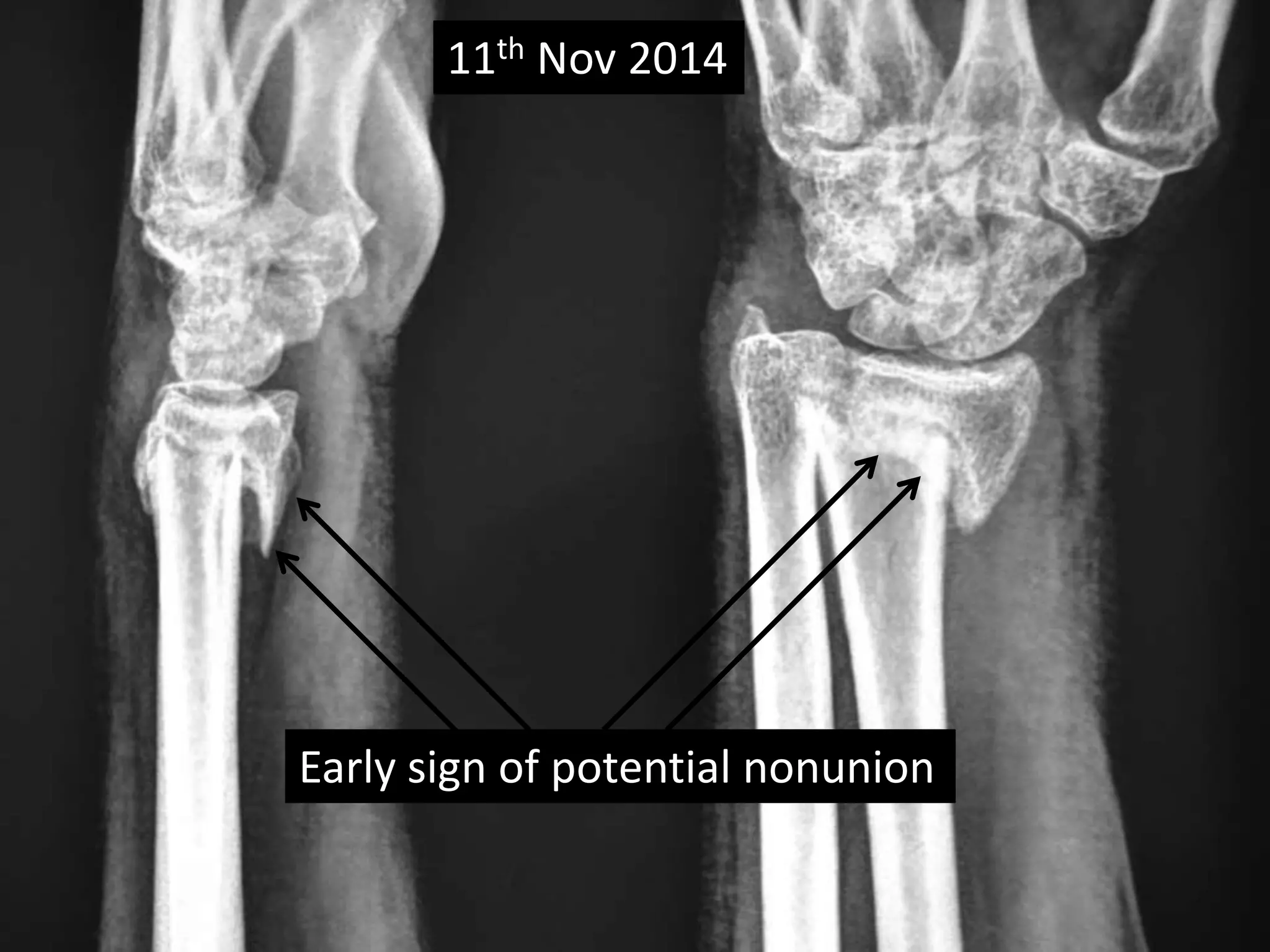 11th Nov 2014 
Early sign of potential nonunion 
 
