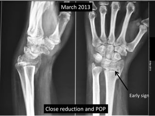 March 2013 
Close reduction and POP 
Early sign 
 