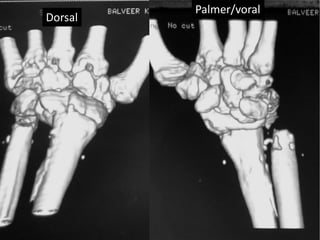 Dorsal 
Palmer/voral 
 