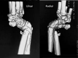 Ulnar Radial 
 