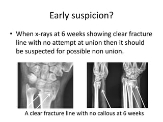 Early suspicion? 
• When x-rays at 6 weeks showing clear fracture 
line with no attempt at union then it should 
be suspected for possible non union. 
A clear fracture line with no callous at 6 weeks 
 