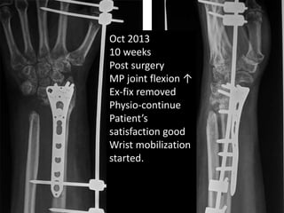 Oct 2013 
10 weeks 
Post surgery 
MP joint flexion ↑ 
Ex-fix removed 
Physio-continue 
Patient’s 
satisfaction good 
Wrist mobilization 
started. 
 