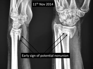 11th Nov 2014 
Early sign of potential nonunion 
 