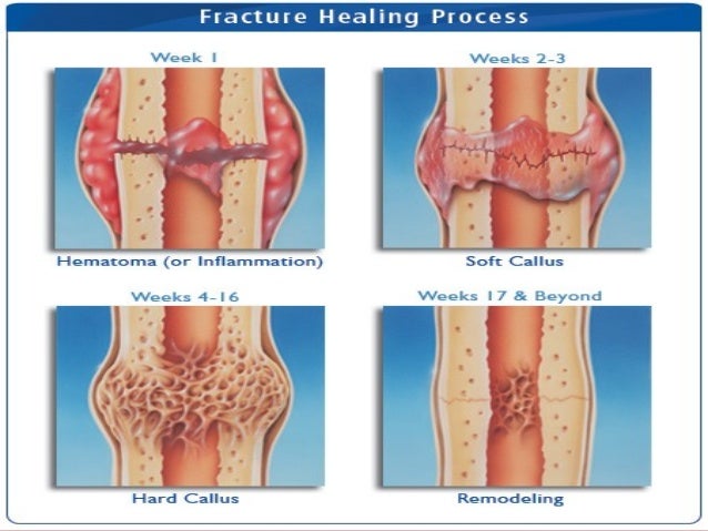 Nonunions of long bones akbar