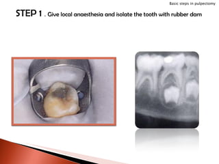 STEP 1  .  Give local anaesthesia and isolate the tooth with rubber dam Basic steps in pulpectomy 