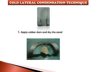 1.  Apply rubber dam and dry the canal COLD LATERAL CONDENSATION TECHNIQUE 