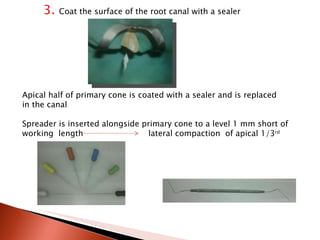 3.  Coat the surface of the root canal with a sealer Apical half of primary cone is coated with a sealer and is replaced  in the canal Spreader is inserted alongside primary cone to a level 1 mm short of  working  length  lateral compaction  of apical 1/3 rd   