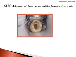 STEP 3  :  Remove roof of pulp chamber and identify opening of root canals Basic steps in pulpectomy 