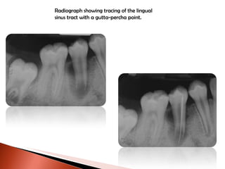Radiograph showing tracing of the lingual sinus tract with a gutta-percha point. 
