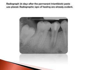 Radiograph 26 days after the permanent triantibiotic paste was placed. Radiographic signs of healing are already evident. 