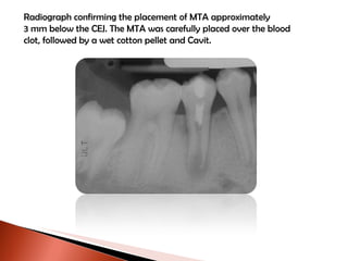 Radiograph confirming the placement of MTA approximately 3 mm below the CEJ. The MTA was carefully placed over the blood clot, followed by a wet cotton pellet and Cavit. 