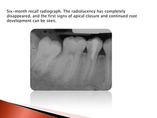 Six-month recall radiograph. The radiolucency has completely disappeared, and the first signs of apical closure and continued root development can be seen. 