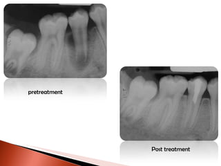 pretreatment Post treatment 