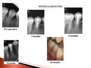 REVASCULARISATION 