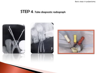 STEP 4  :  Take diagnostic radiograph Basic steps in pulpectomy 