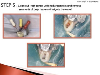 STEP 5  : Clean out  root canals with hedstroem files and remove remnants of pulp tissue and irrigate the canal Basic steps in pulpectomy 