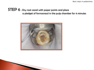 STEP 6  :  Dry root canal with paper points and place a pledget of formocresol in the pulp chamber for 4 minutes Basic steps in pulpectomy 