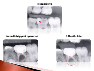 Preoperative Immediately post operative 3 Months later 