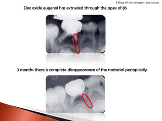 Zinc oxide eugenol has extruded through the apex of 85 3 months there is complete disappearance of the material periapically Filling of the primary root canals 