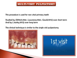This procedure is used for non vital primary teeth Studied by (Wittch,1956 ; Lawrence,1966 ; Gould,1972) over short term  And by ( starky,1973) over long term The clinical technique is similar to the single visit pulpectomy MULTI-VISIT  PULPECTOMY 