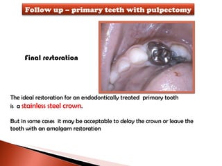 Final restoration The ideal restoration for an endodontically treated  primary tooth  is  a  stainless steel crown .  But in some cases  it may be acceptable to delay the crown or leave the tooth with an amalgam restoration Follow up – primary teeth with pulpectomy 