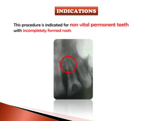 This procedure is indicated for  non vital permanent teeth  with  incompletely formed roots INDICATIONS 
