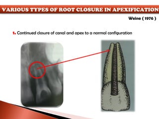 1.  Continued closure of canal and apex to a normal configuration Weine ( 1976 ) VARIOUS TYPES OF ROOT CLOSURE IN APEXIFICATION 