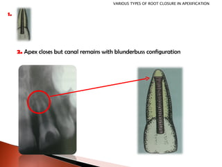 2.  Apex closes but canal remains with blunderbuss configuration 1. VARIOUS TYPES OF ROOT CLOSURE IN APEXIFICATION 
