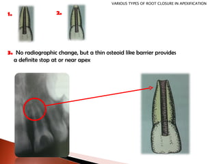 3.  No radiographic change, but a thin osteoid like barrier provides  a definite stop at or near apex 1. 2. VARIOUS TYPES OF ROOT CLOSURE IN APEXIFICATION 
