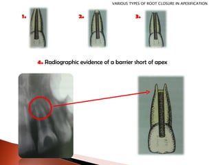 4.  Radiographic evidence of a barrier short of apex 1. 2. 3. VARIOUS TYPES OF ROOT CLOSURE IN APEXIFICATION 