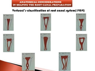 Vertucci’s classification of root canal system(1984) ANATOMICAL CONCIDERATIONS  IN SHAPING THE ROOT CANAL PREPARATION 