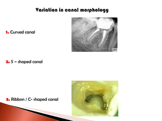 Variation in canal morphology 1.  Curved canal 2.  S – shaped canal 3.  Ribbon / C- shaped canal 