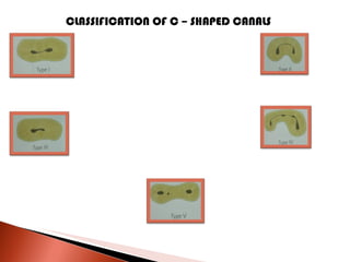 CLASSIFICATION OF C – SHAPED CANALS 