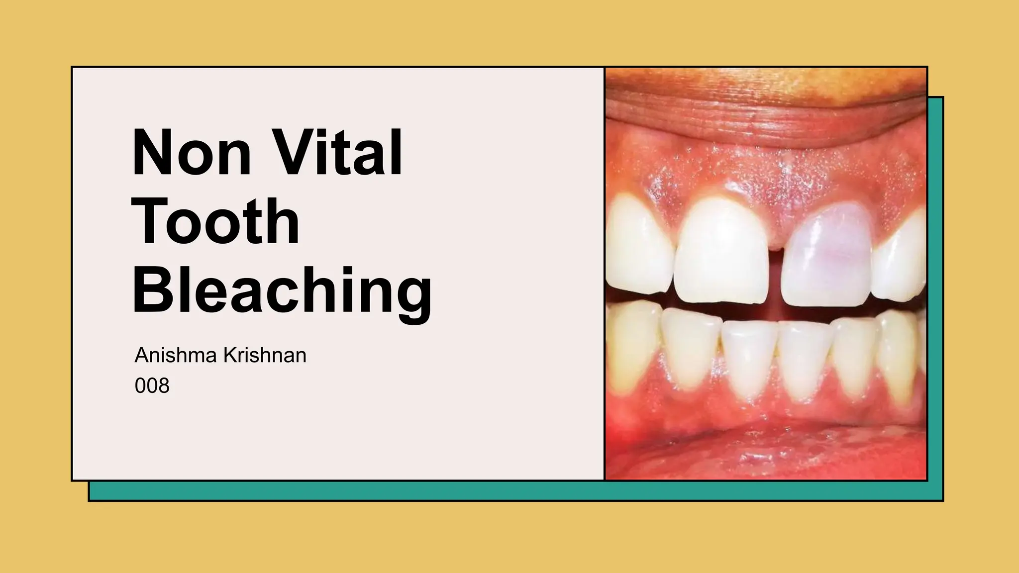 Non Vital Tooth Bleaching .pptx conservative and endodontics PPT