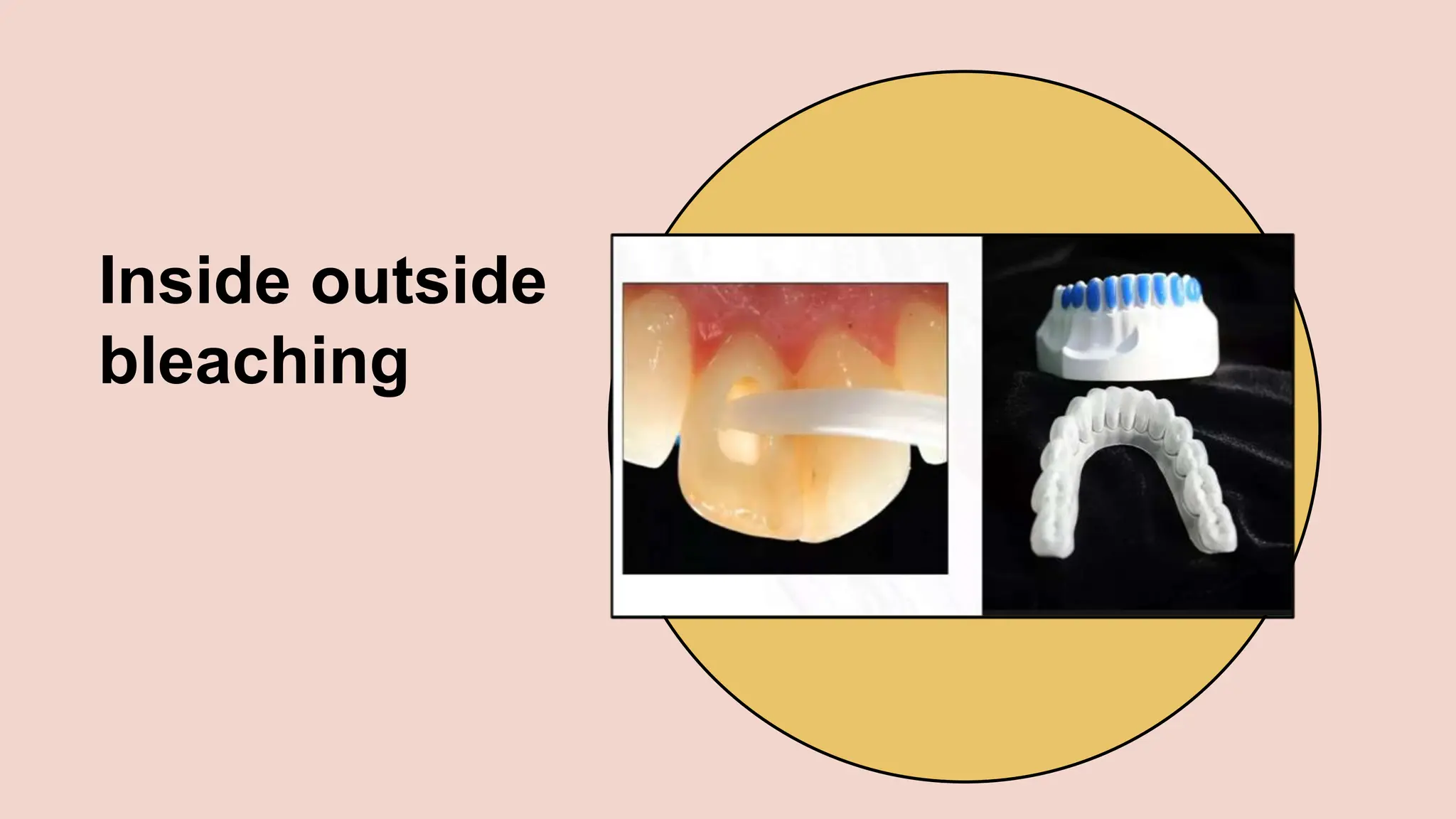 Non Vital Tooth Bleaching .pptx- conservative and endodontics | PPTX