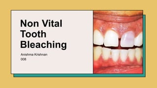 Non Vital
Tooth
Bleaching
Anishma Krishnan
008​
 