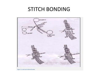 STITCH BONDING
 