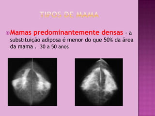  Mamas   predominantemente densas - a
 substituição adiposa é menor do que 50% da área
 da mama . 30 a 50 anos
 