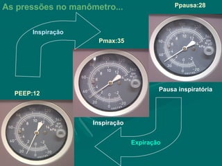 PEEP:12
Pmax:35
Ppausa:28
Inspiração
As pressões no manômetro...
Expiração
Pausa inspiratória
Inspiração
 