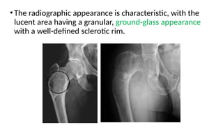 Glass Radiograph bone tumours fibrous and non fibrous lesions.pptx