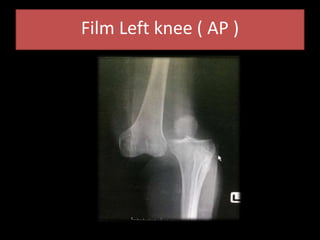 Film Left knee ( AP )
 