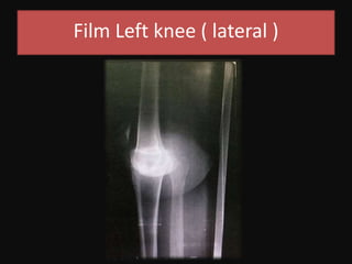 Film Left knee ( lateral )
 